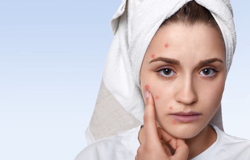 Acne & Pimples Treatment in Ranchi by Dr. Sanjay Kumar