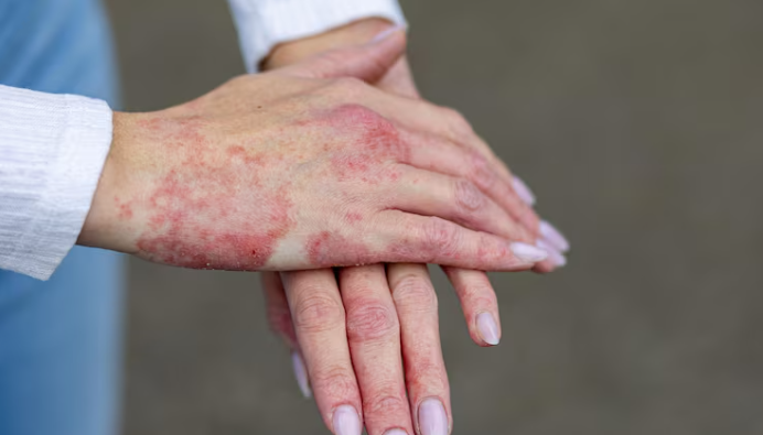 Eczema Treatment in Ranchi by Dr. Sanjay Kumar