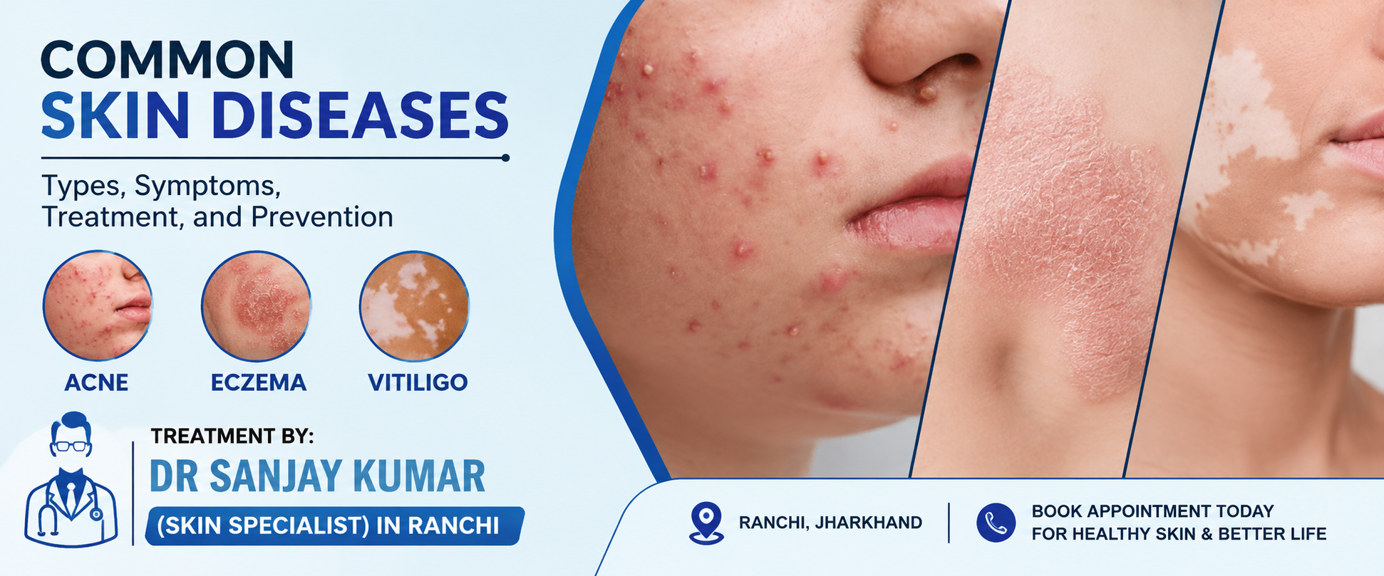 Skin Disease Treatment in Ranchi by Dr. Sanjay Kumar